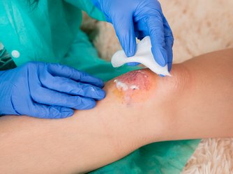 Wundbehandlung am Knie